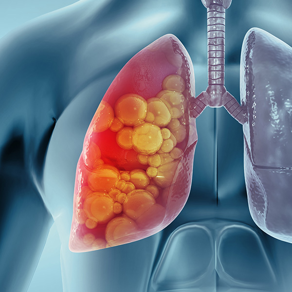 Medical Illustration showing lung cancer or bronchial carcinoma